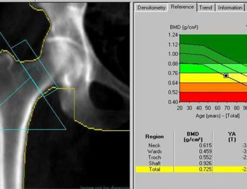 Why Bone Health Matters: Understanding Bone Density